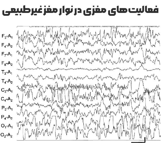 فعالیت‌های مغزی در نوار مغز غیرطبیعی