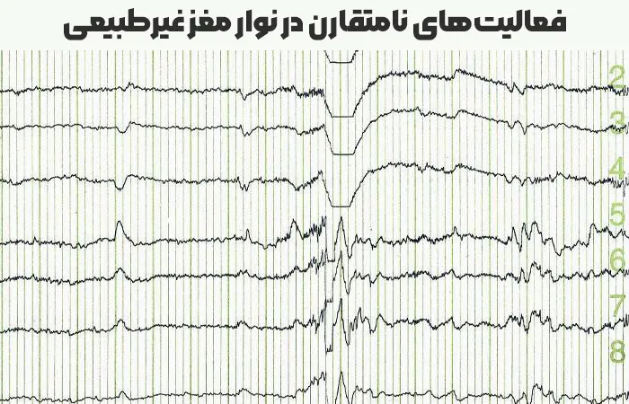 فعالیت‌های نامتقارن در نوار مغز غیرطبیعی