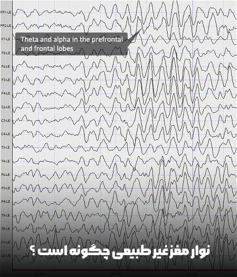 عکس نوار مغز غیر طبیعی