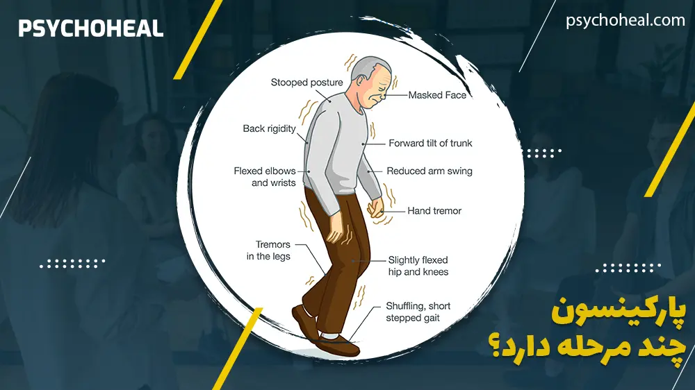 پارکینسون چند مرحله دارد؟